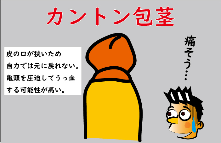 カントン包茎