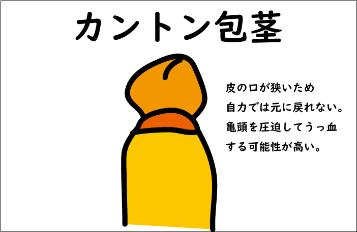 カントン包茎